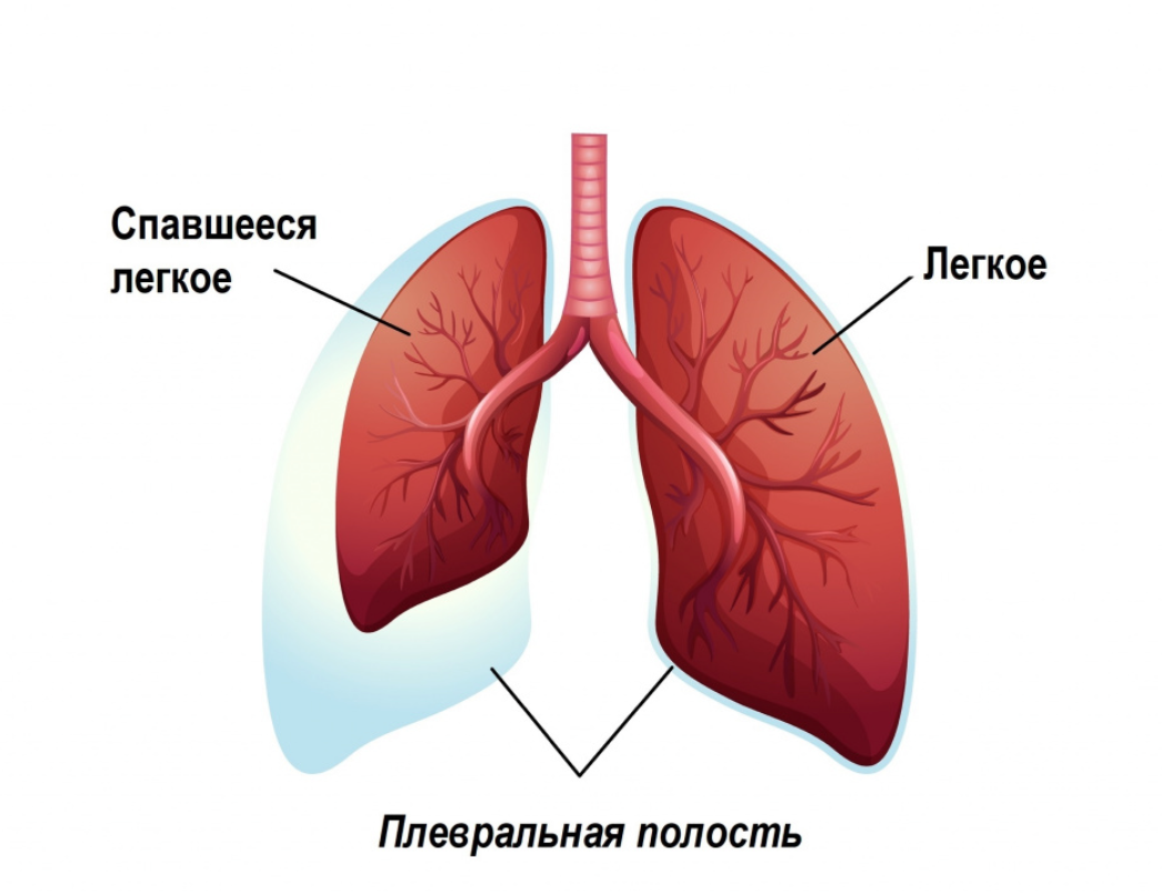 Что такое коллапс легкого? Коллапс легкого возникает, когда воздух попадает в плевральную полость, область между грудной стенкой и легким.