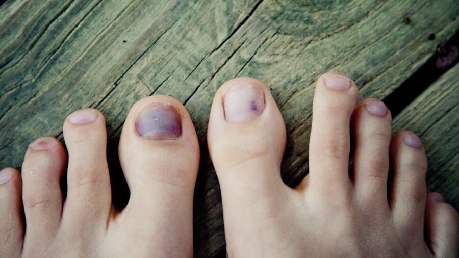 Гематомы ногтей — когда следует прибегнуть к помощи специалиста?