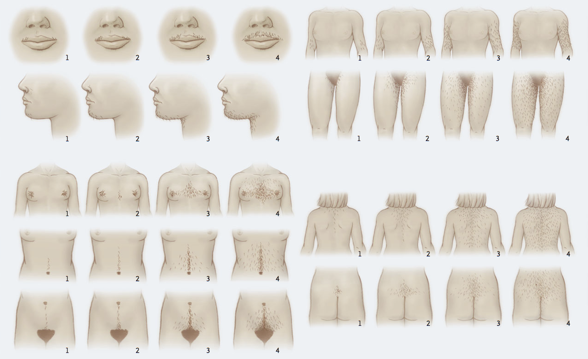 Баллы: 0 — волос нет (только пушок); 1 — единичные волосы; 2 — рассеянные единичны волосы; 3 — незначительное оволосение; 4 — загущенный рост волос.
