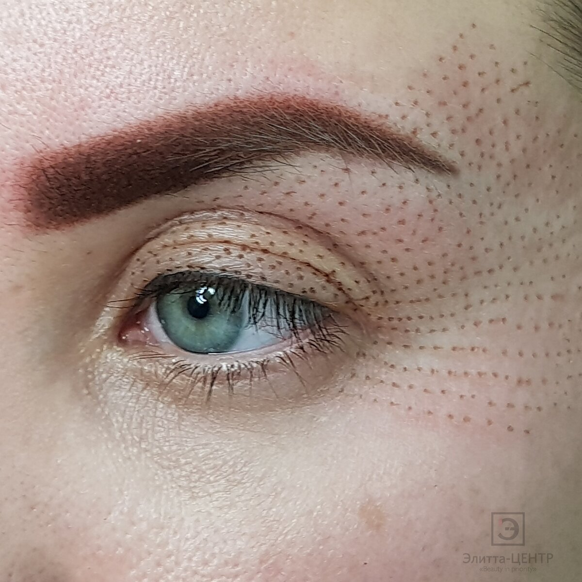 Что вы знаете о плазменном омоложении?