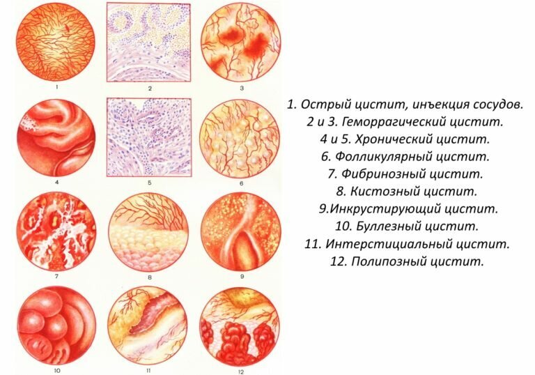 Цистит: симптомы, лечение, профилактика