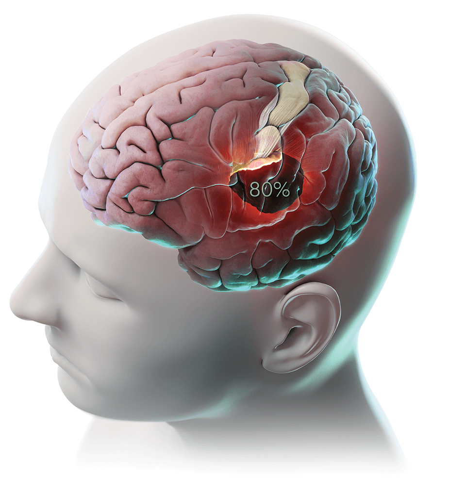 Открытая травма мозга. Черепно-мозговая травма (ЧМТ). Серепномозговая травма. Черепномозговые травы. Черепномазштвая травма.
