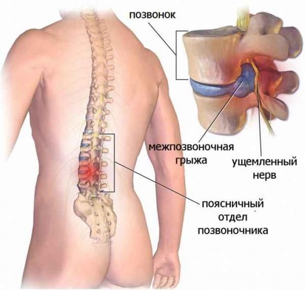 Профилактика остеохондроза в Харькове - Медицинский центр Бубновский