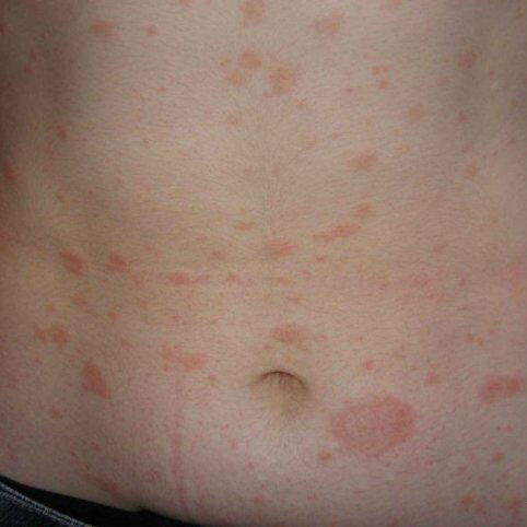 псориаз на животе фото