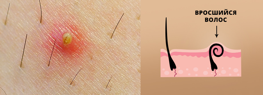 Вросший волос