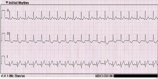 Тахикардия