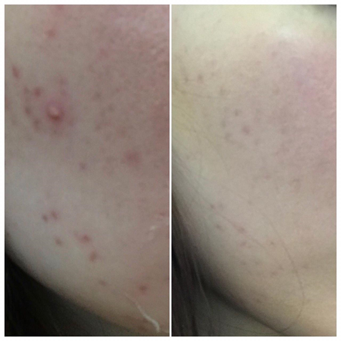 мое промежуточное до-после, сейчас ситуация еще лучше, правда фото новых нет