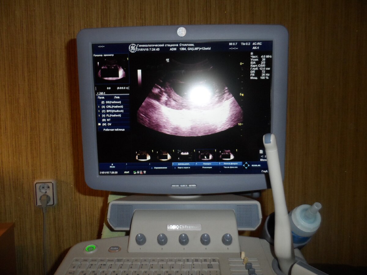 Вот таким образом, на экране, врач увидит дефекты развития