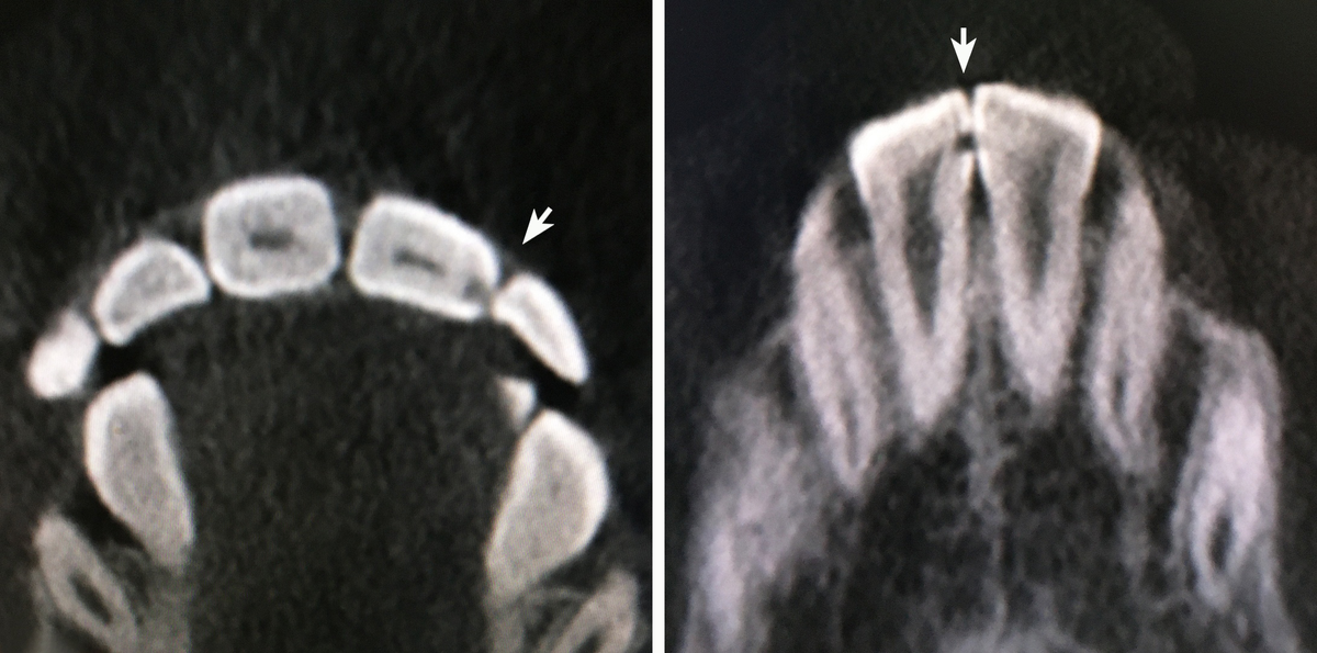 Это компьютерная томография зубов с контактным кариесом.