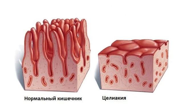 Что такое глютен? Вред и польза глютена