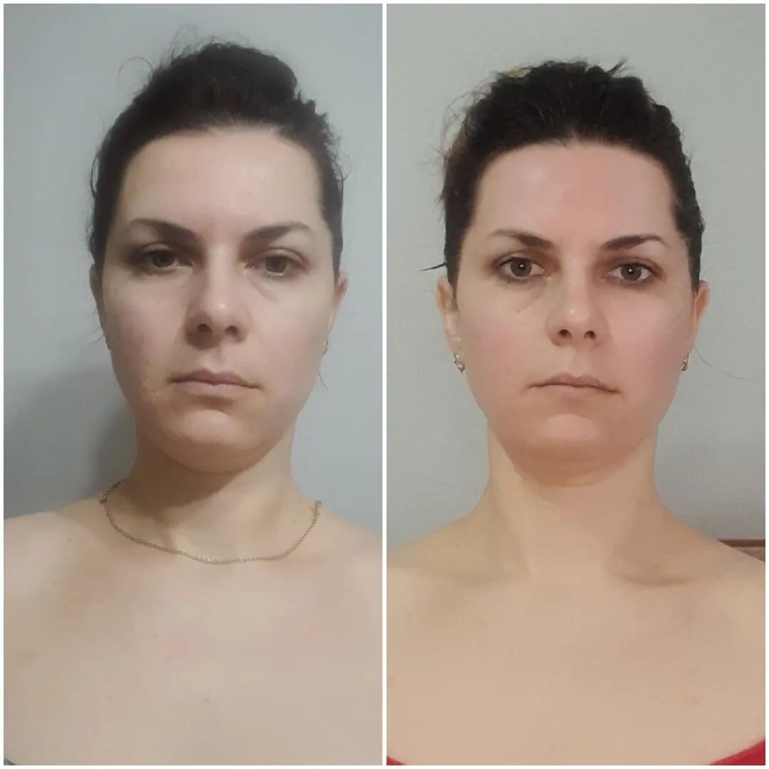 Ручная пластика лица 10 процедур