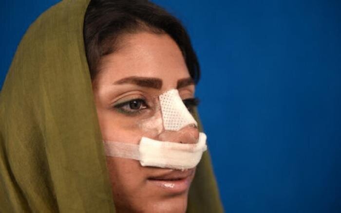 Пластическая хирургия в Иране