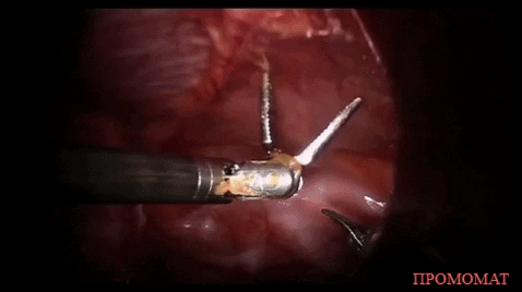 Начало операции с роботизированным ассистентом.