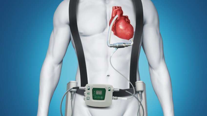 Источник фото: https://forpost-sz.ru/a/2019-01-30/v-peterburge-vpervye-vzhivili-iskusstvennoe-serdce-novogo-pokoleniya