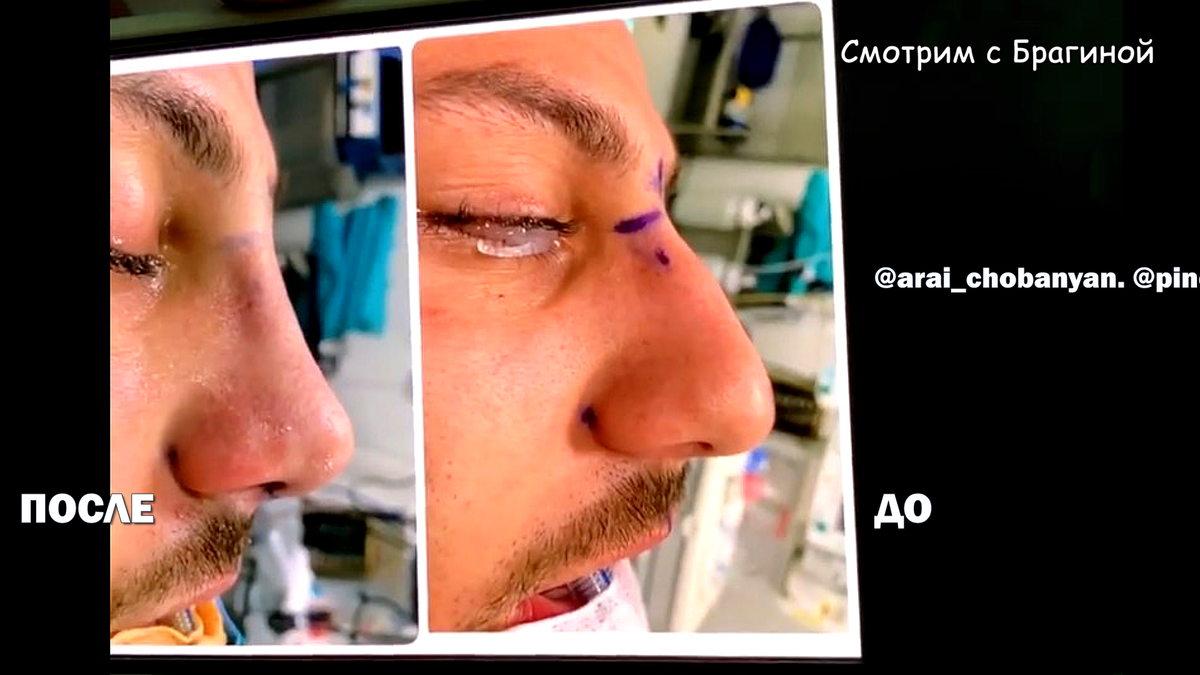 Нос Арая ПОСЛЕ и ДО ринопластики, фото: @arai_chobanyan, @pinchuk_official