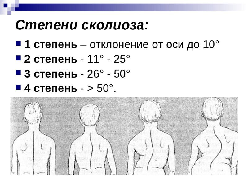 Сколиоз 1 степени группа здоровья