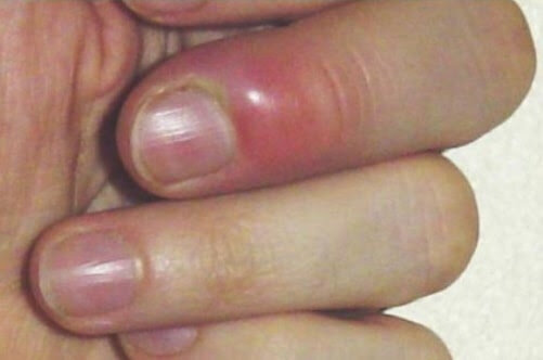 Самой частой причиной появления признаков воспаления около ногтя является его врастание в кожу. А самая частая причина этого – неправильно подобранная обувь и неправильное подрезание ногтей.