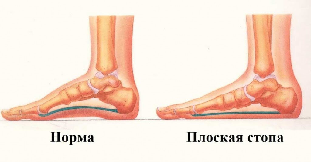 Для примера нашел как выглядит моя стопа на рентгене (справа). Фото: 7010303.ru