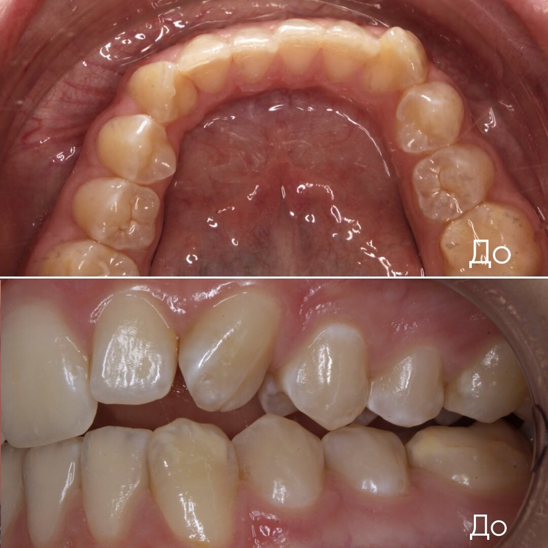эмаль зубов имеет обширные повреждения