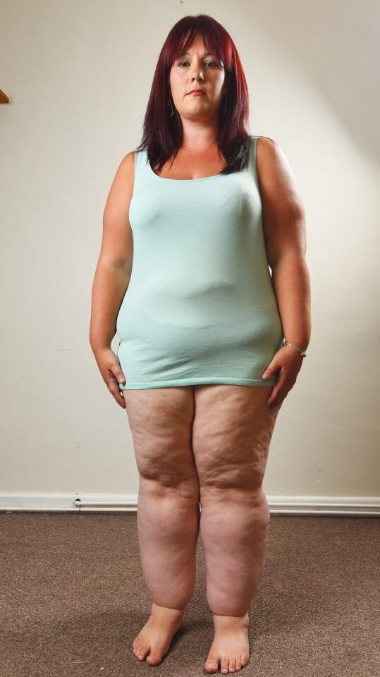 Лимфатический отек - щиколотки опухшие, при том что вес у девушки не то чтобы критический, а щиколотки как-будто она за 300кг перевалила 