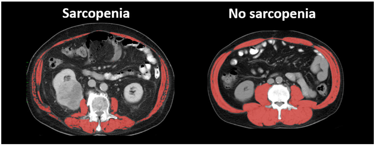 Саркопения. Саркопения на кт. Саркопения диагностика. Мрт при саркопении.
