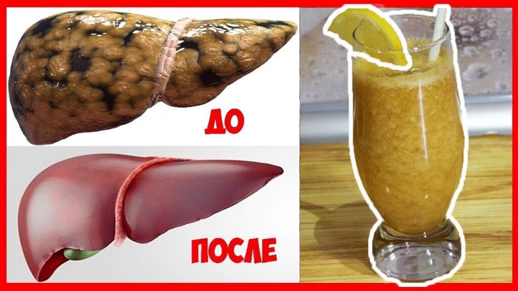 Печень не нуждается в очистке. На фото "до" - неалкогольная жировая болезнь печени. Ваша без всяких лекарств выглядит как на картинке "после"