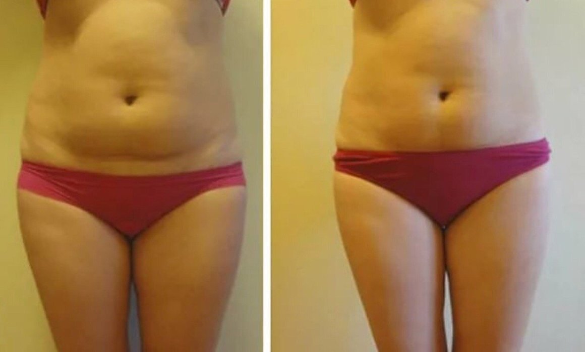 Фото плоского живота при помощи нити ДО и ПОСЛЕ.