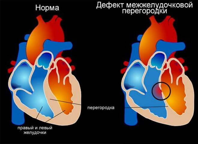 Порок сердца: что это, виды, симптомы, диагностика, лечение, профилактика