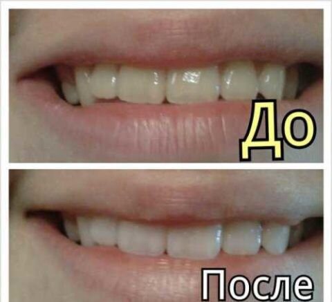 Результат отбеливания на лицоAds by optAd360