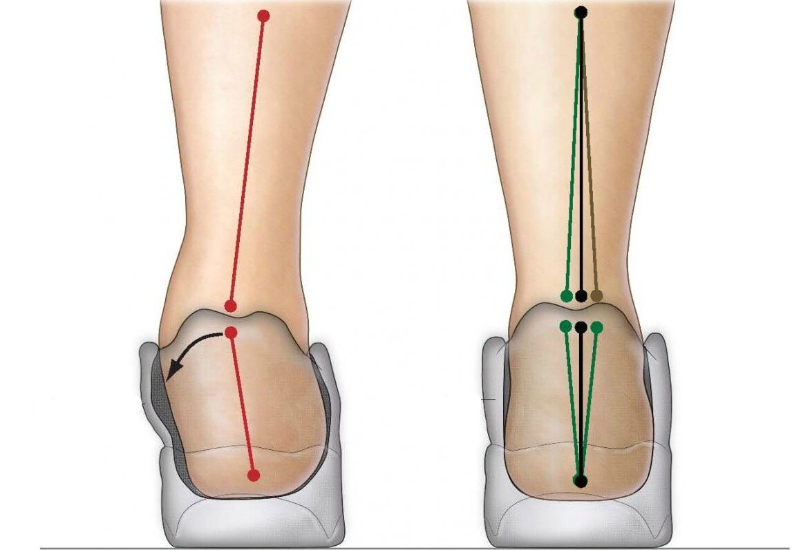 Пронация и гиперпронация стопы: причины, симптомы и лечение