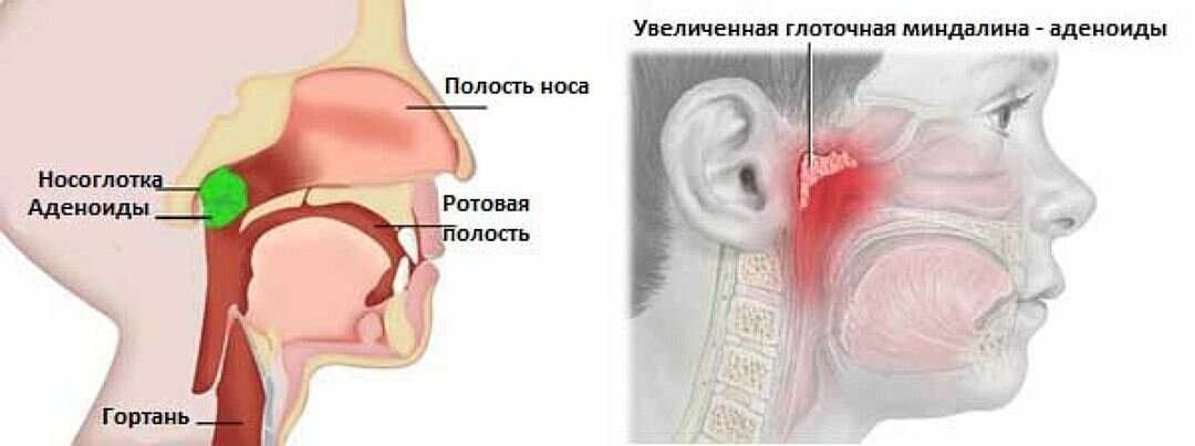 Что такое аденоиды у ребенка