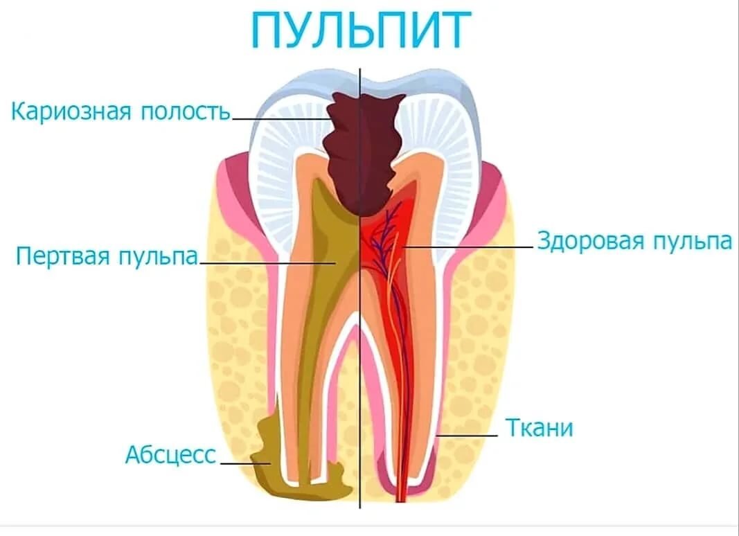 Пульпит - лечение зубов
