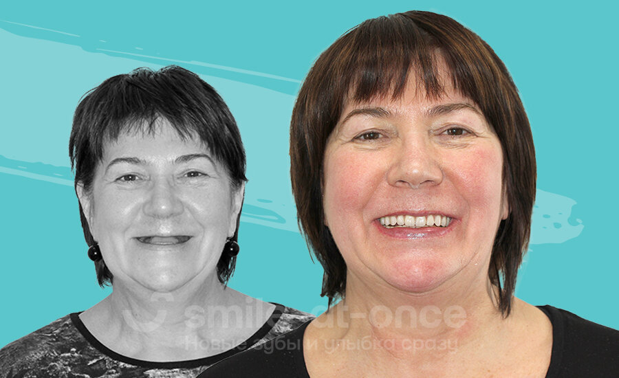 Фото пациентов клиники Smile-at-Once до и после установки комфортных протезов. Беззубая жизнь позади! Фото: Smile-at-Once.ru.