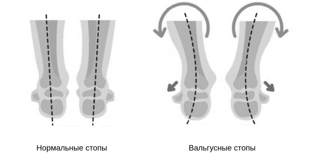 Нормальные и вальгусные стопы 