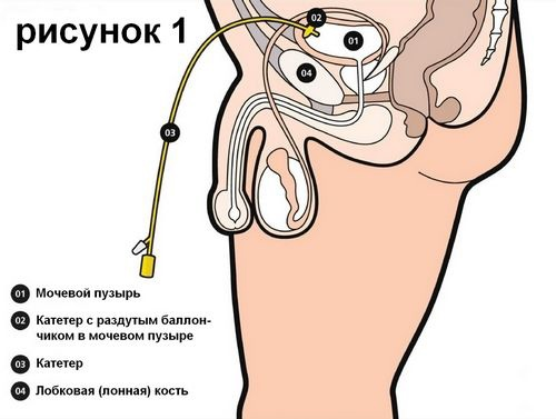 Эпицистостома что это