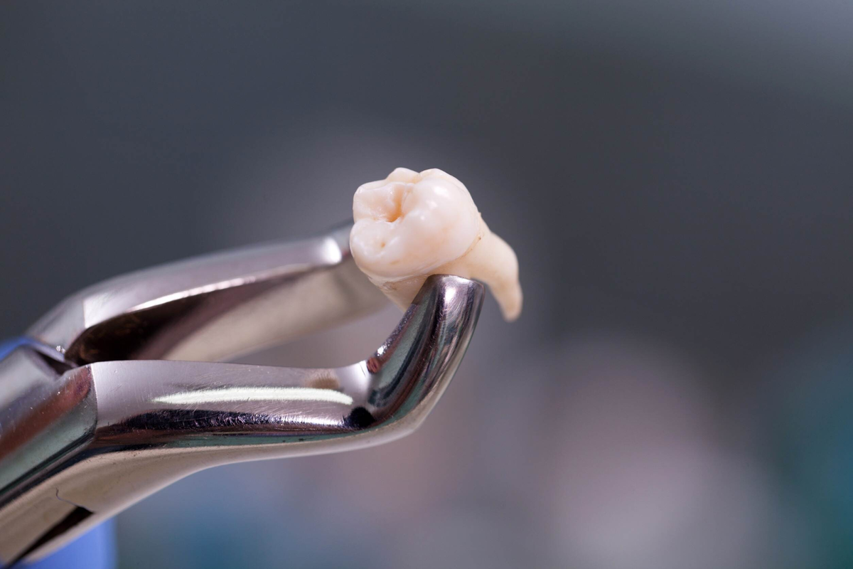Если неправильно ухаживать за лункой после удаления зуба, она будет долго заживать. Или того хуже — в ней разовьется инфекция. Рассказываем, чего нельзя делать в первые дни после операции.