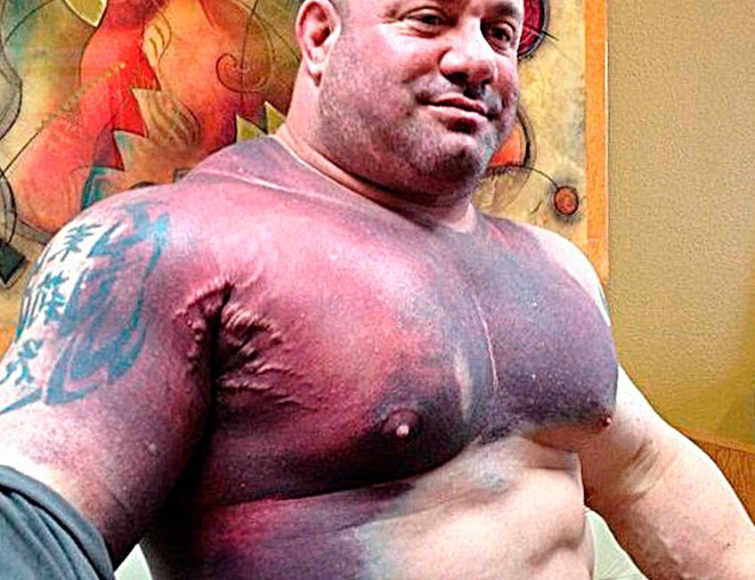 Гематома в следствии разрыва грудной мышцы