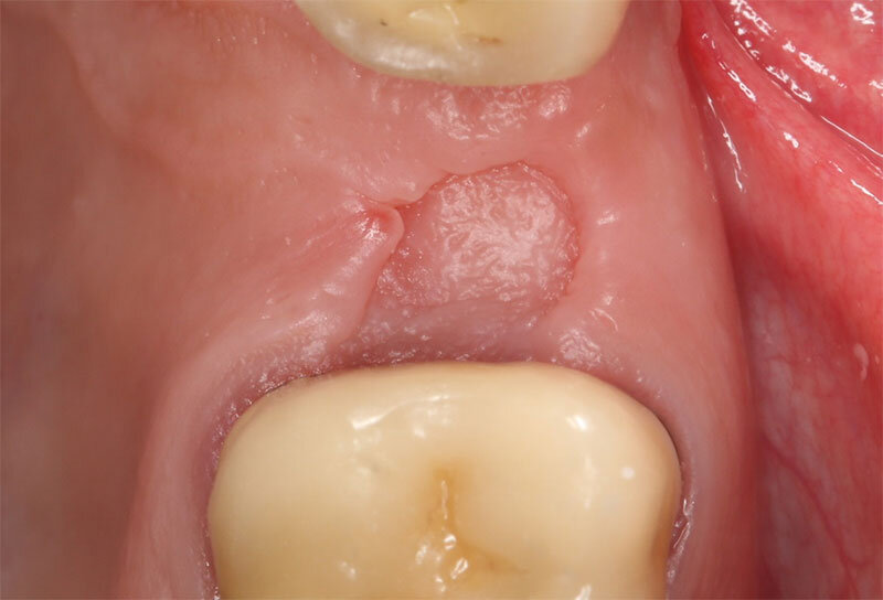 Как заживает лунка после удаления зуба? Фото процесса