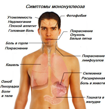 Мононуклеоз: возбудитель, симптомы, осложнения