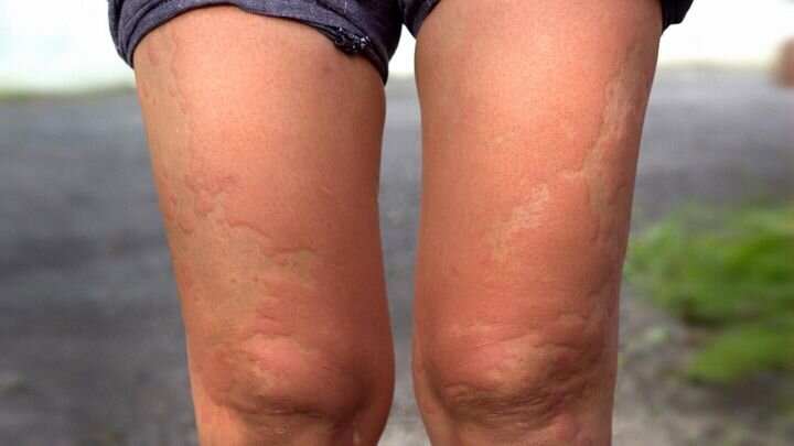 Навязчивый и мучительный зуд кожи ног может быть вызван десятками различных инфекций.