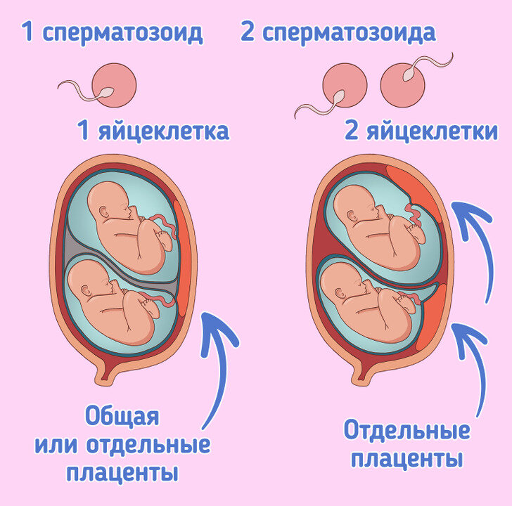 Однояйцевые близнецы. Однояйцевая двойня. Виды однояйцевых близнецов. Близнецы в разных плацентах.