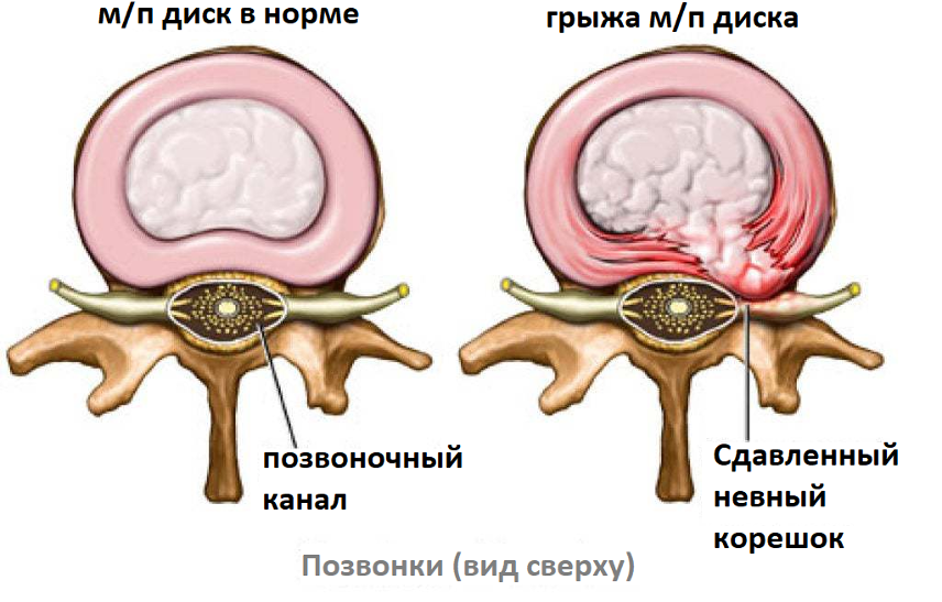 Протрузия что это. Протрузия межпозвоночного диска. Позвоночник диск l5-s1 грыжа. Протрузия межпозвонковых дисков. Студенистое ядро межпозвоночного диска.