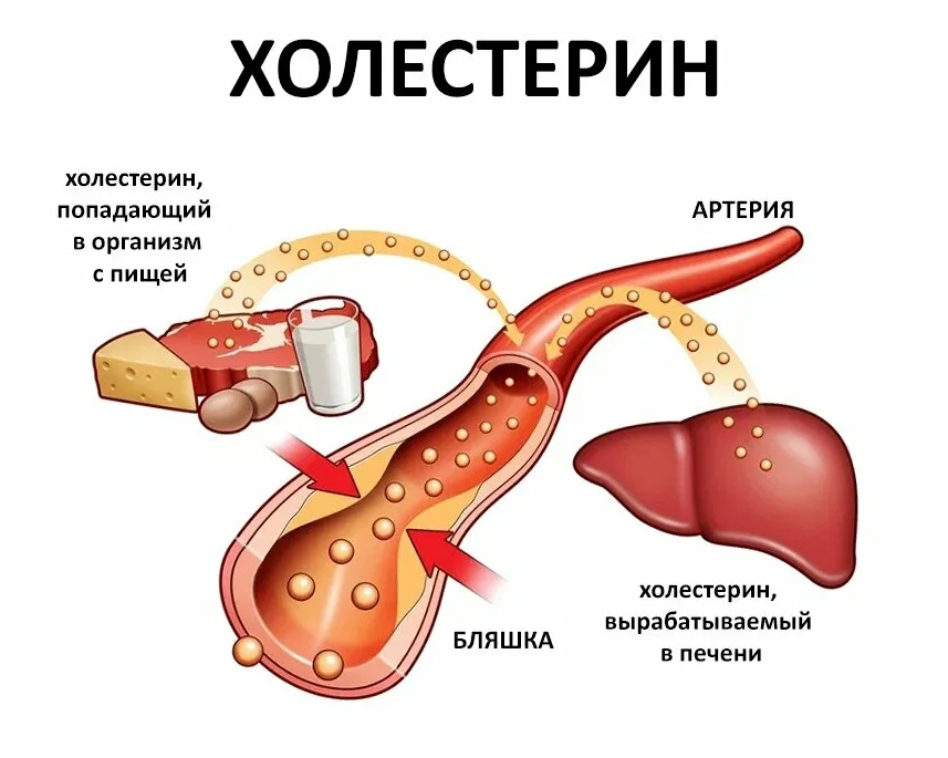 Плохой холестерин. Повышение уровня холестерина в крови. XALESTERIN. Повышенный уровень холестерина.