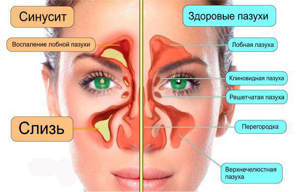 Хроническая заложенность носа у взрослых. Риносинусит острый риносинусит. Различие синусита и гайморита. Гайморит синусит фронтит ринит. Синусит фронтит гайморит разница.
