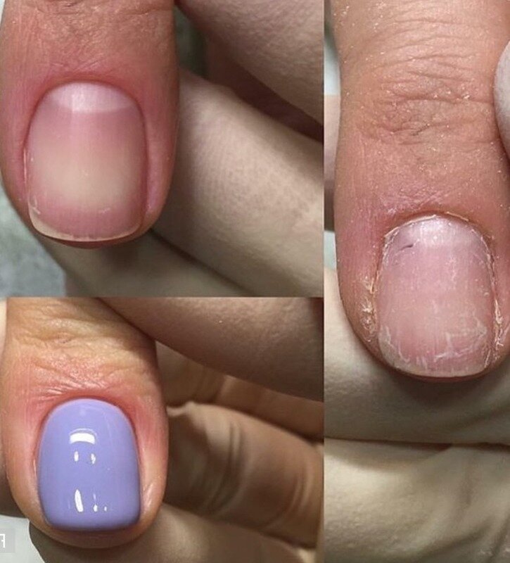 ногти до и после маникюра. пропилы на ногтях после аппаратного маникюра. искривление ногтевой пластины. после аппаратного маникюра. пропилы на ногтях после аппаратного маникюра.