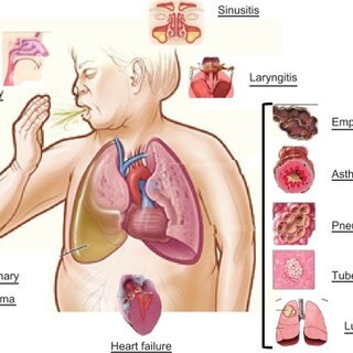 В современной медицине под желудочным подразумевают кашель, который спровоцирован заболеваниями ЖКТ. Круг патологий очень большой.