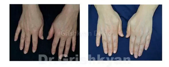 липофилинг кистей