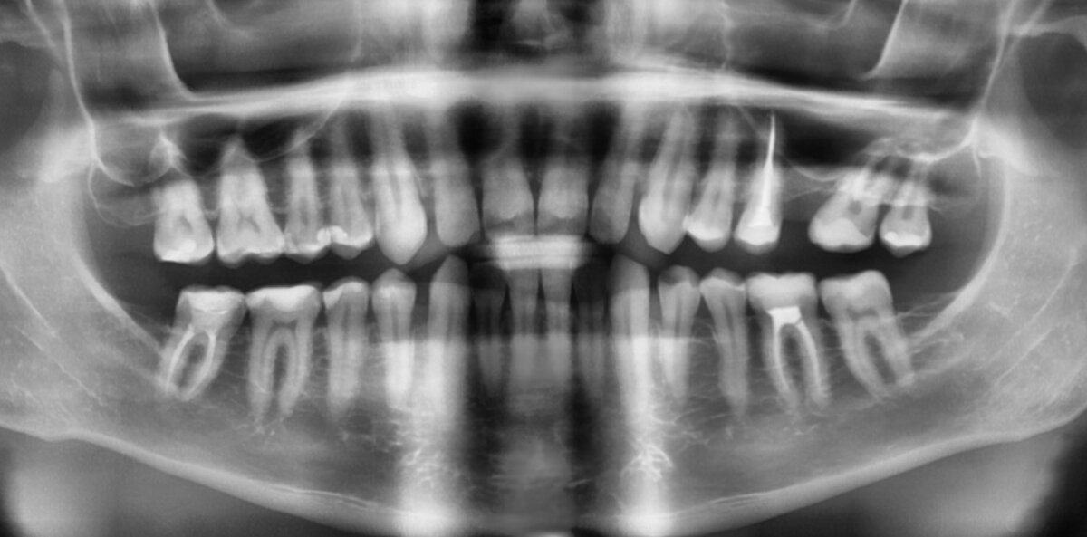 ортопантомограмма  от 5 декабря 2022 года