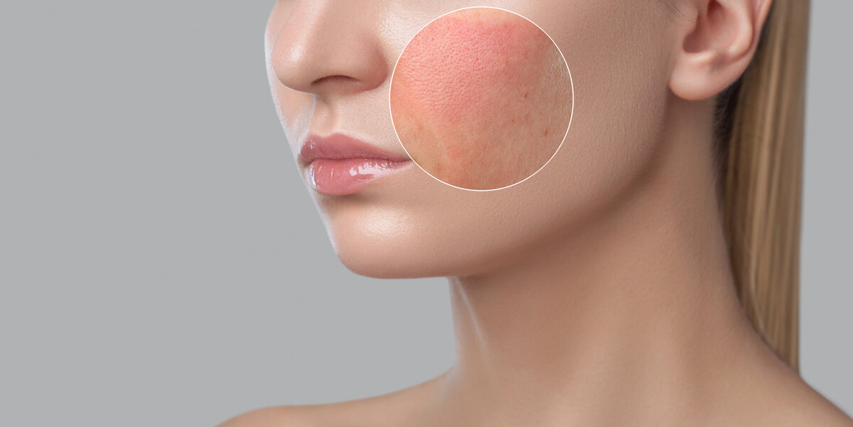 Аллергия на крем для лица: подбираем безопасную альтернативу | Woman.ru |  Дзен
