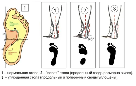 Полой стопе. Высокий свод стопы рентген. Полая стопа с высоким сводом. Паралитическая полая стопа.